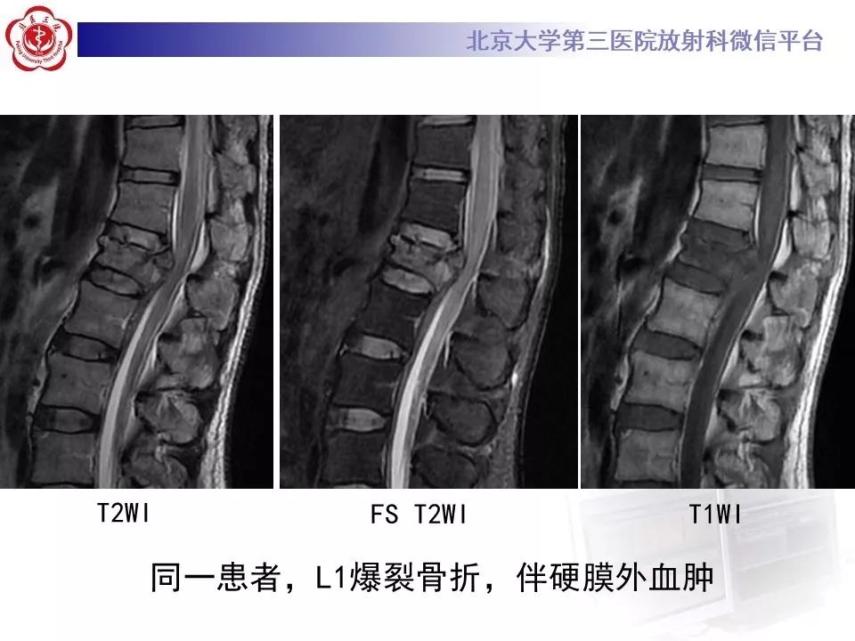 「每日一例｜893例」女，49岁，摔伤致腰部疼痛，活动受限1天
