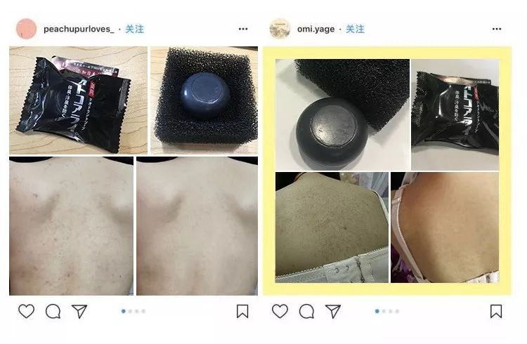 20分钟清理背部螨虫痘痘,十秒去除螨虫