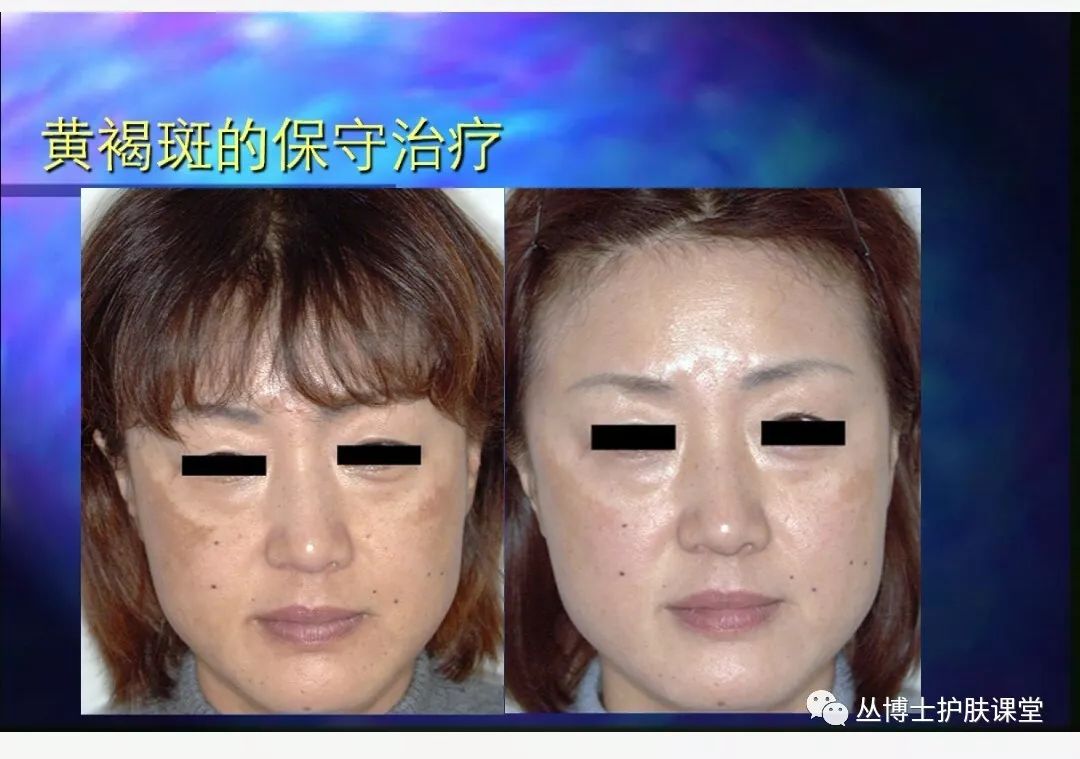 治疗褐斑病的偏方,褐斑病怎样才叫治愈好