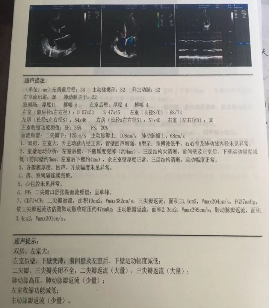 sglt-2抑制剂治疗心衰指南,临床心衰治疗药