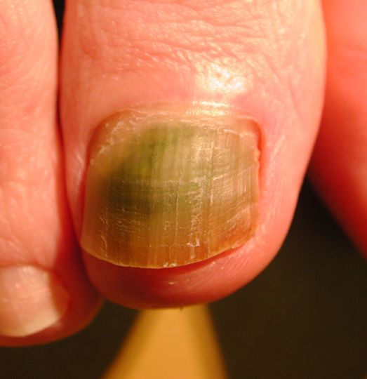 指甲很脆是因为缺少什么营养素,婴儿指甲特别脆是缺乏营养么