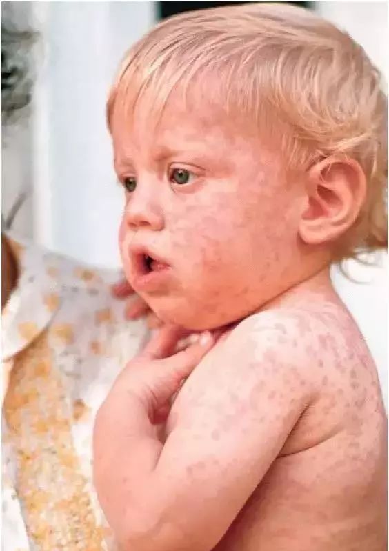 夏季手足口病的预防小知识,手足口水痘注意事项