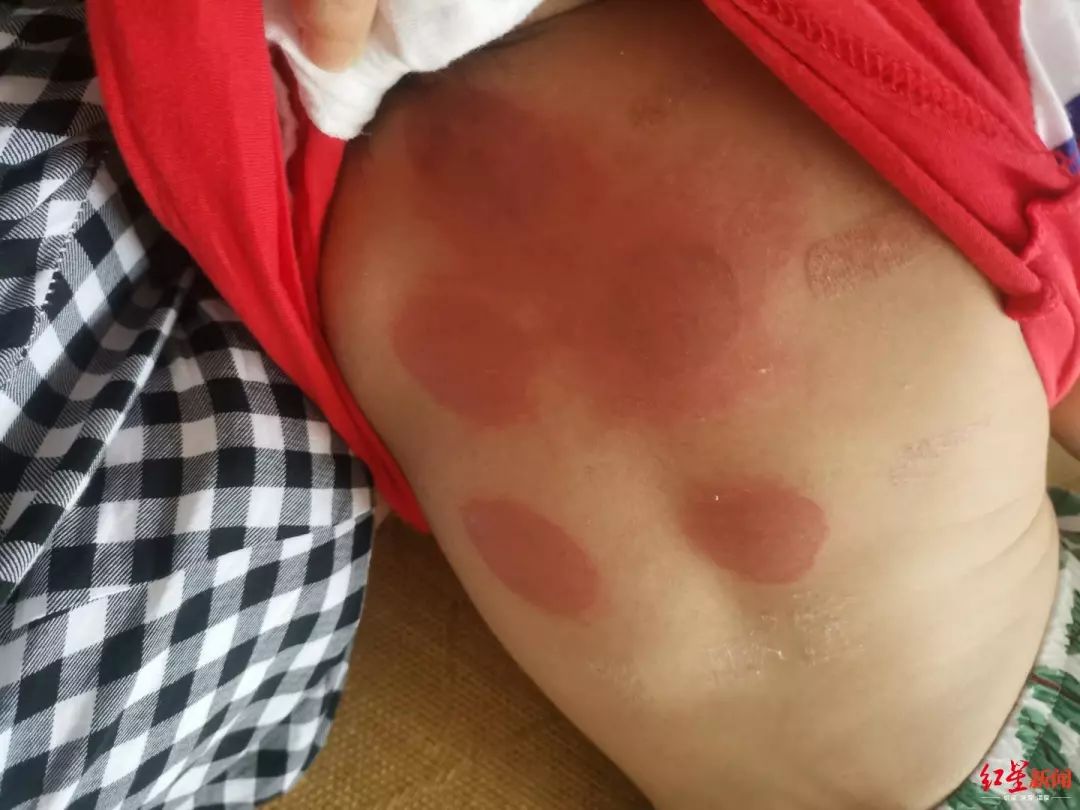 92名儿童被三伏贴灼伤看着心疼,92名儿童贴三伏后被烧伤
