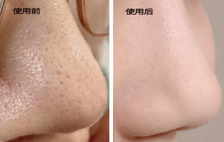 柔嫩抛光|脸上搓出3斤泥！难怪又黄又暗又黑头！10秒给脸蛋“剥壳”，厉害