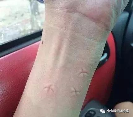 被蚊子咬了特别痒怎么快速止痒,被蚊子咬了痒怎么快速止痒