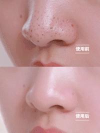 一抹吸出黑头,鸡蛋清除黑头