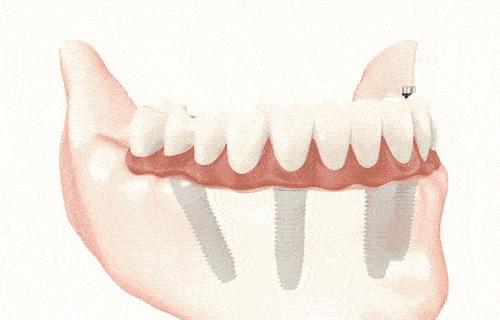 看牙惠民补贴,市民申领看牙补贴套路