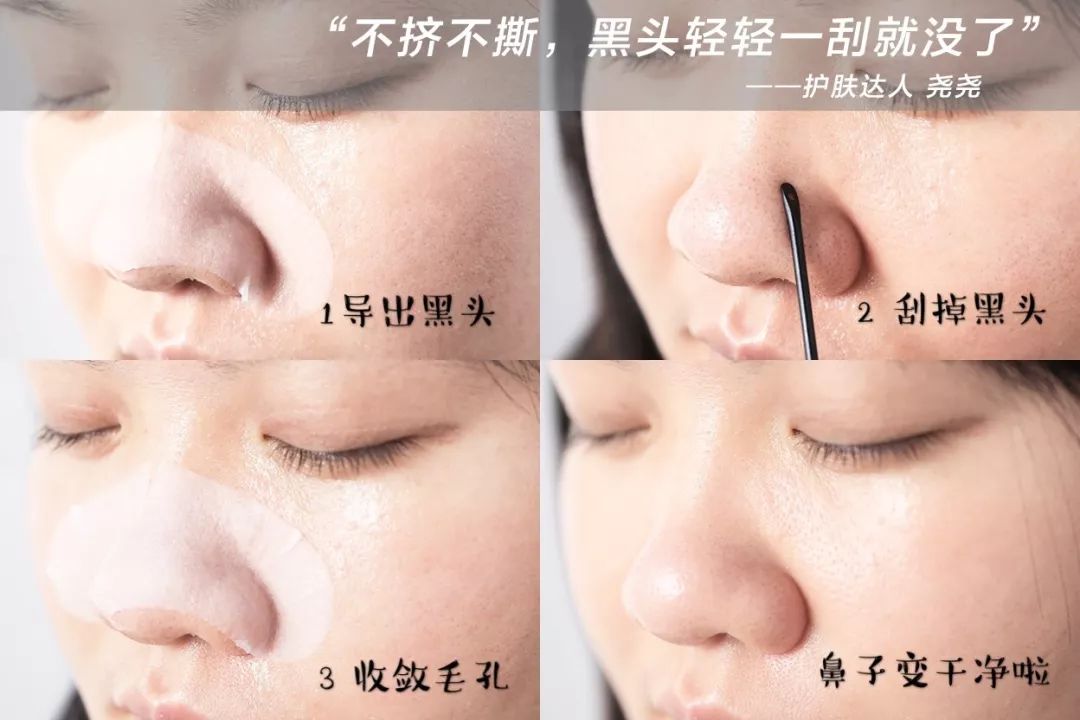 用黑头仪吸完黑头黑头还会再长吗,黑头别膨胀3招把你刷光光