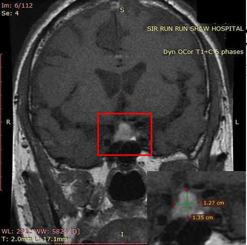 什么?!打嗝止不住是脑子有问题?