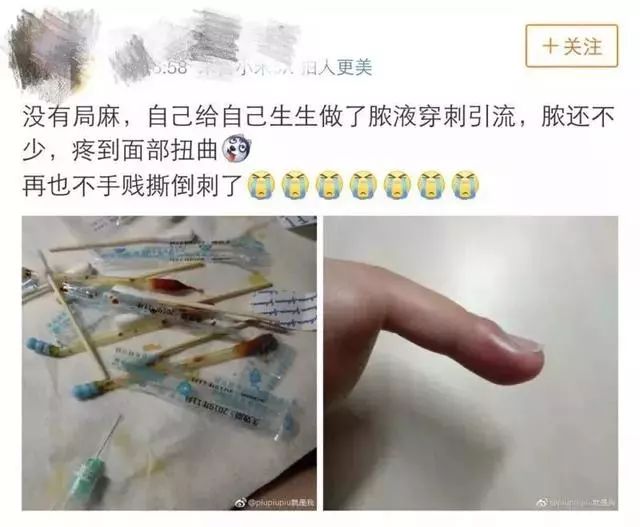 一个没注意,手指倒刺变截指!这个动作千万别再做了!