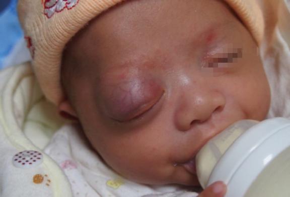 宝宝身上起红点当心这些皮肤病,嘴唇内壁长了个小红点是血管瘤吗