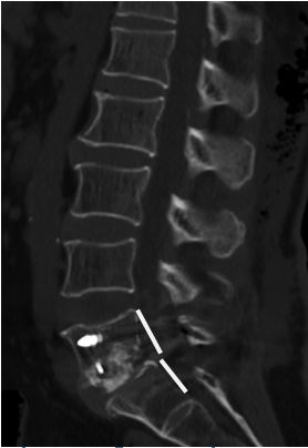 腰椎滑脱怎样做有氧康复训练,腰椎滑脱康复治疗预后