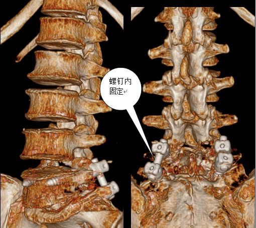 腰椎滑脱怎样做有氧康复训练,腰椎滑脱康复治疗预后