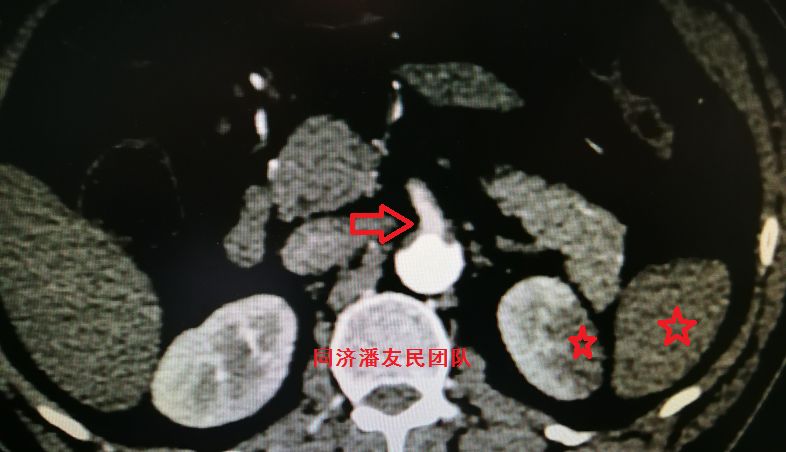主动脉夹层如何快速确诊,确诊主动脉夹层最可靠办法