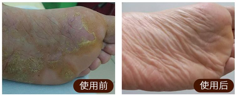 足癣药膏一天涂几次较好,湿疹性皮炎涂了一次药没效果