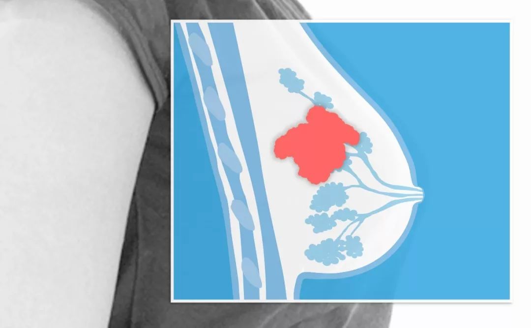 her2乳腺癌最新治疗新药,her2阳性乳腺癌靶向治疗研究进展