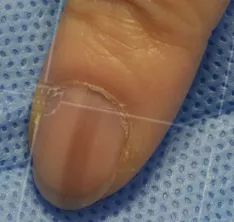 灰指甲致癌吗,灰指甲美甲的禁忌