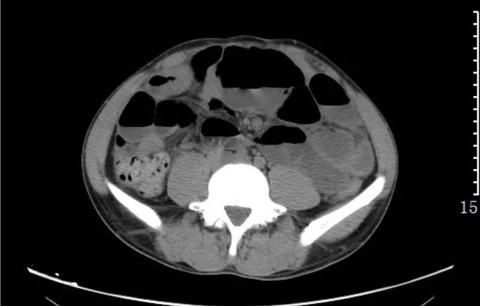 急诊科常见急腹症观察,腹部急诊影像大全值得收藏