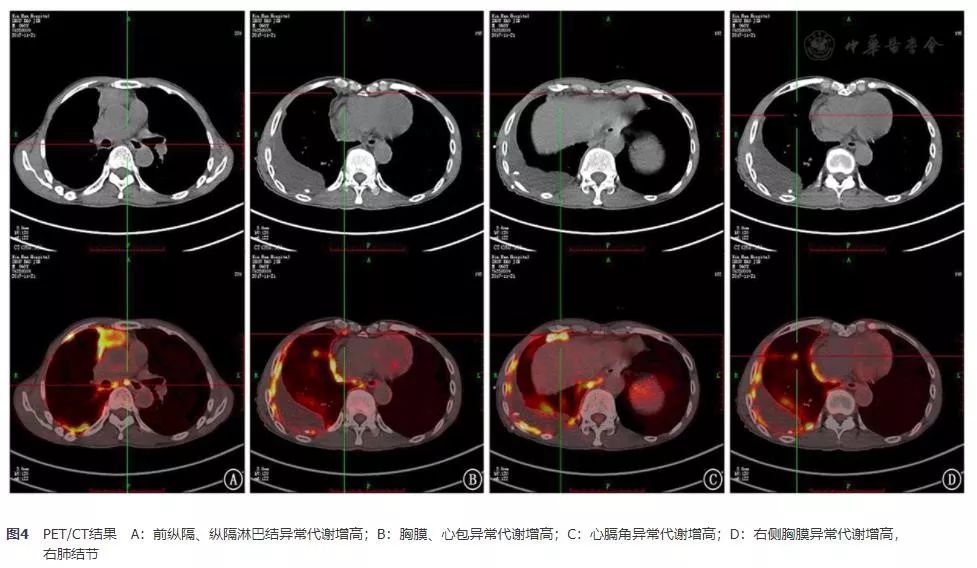 胸腺鳞癌一例并文献复习