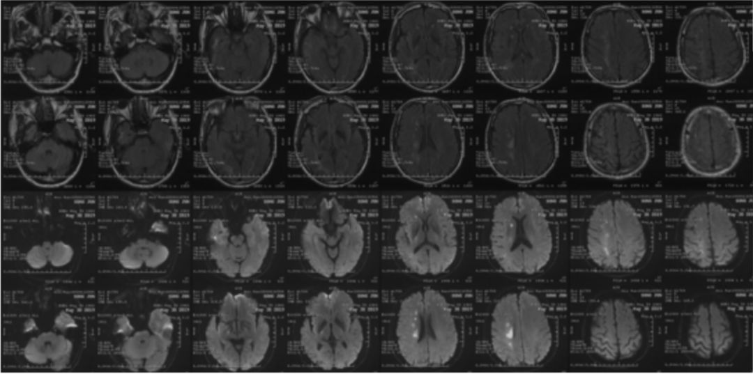 颈内动脉闭塞先进治疗,颈内动脉闭塞开通术病例讨论