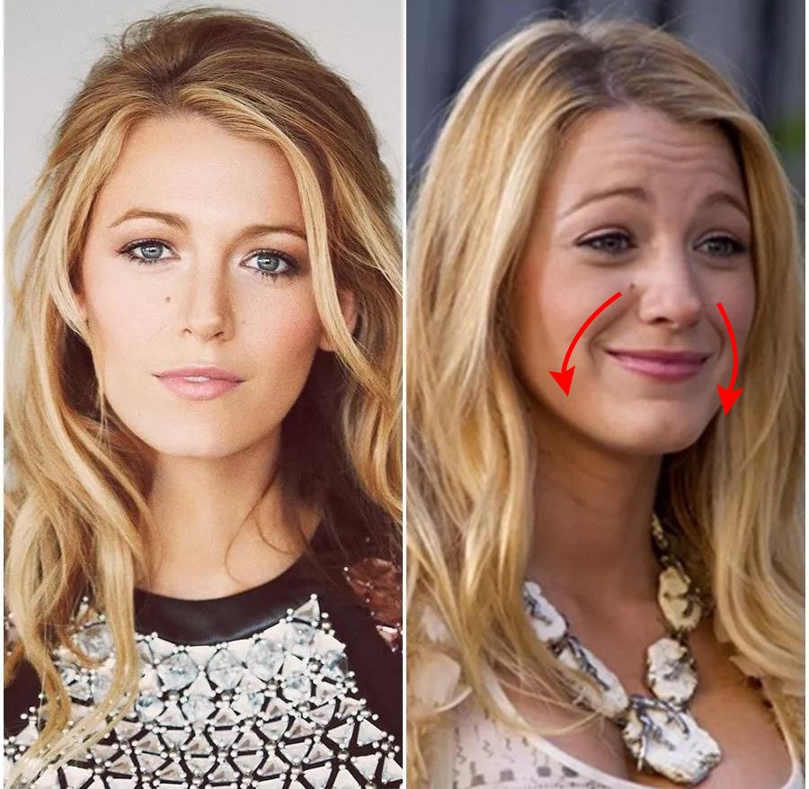 三十岁就有眉间纹法令纹怎么办,30岁法令纹眉心纹深