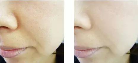 去黑头比较好用的产品,去黑头效果最好的几款产品