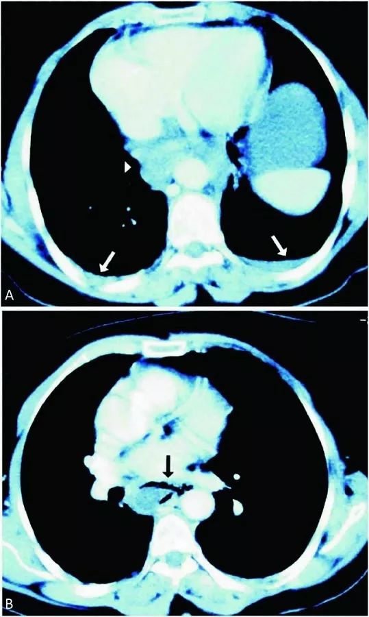 胸疼还有一个坑,胸痛症状缓解可能是陷阱