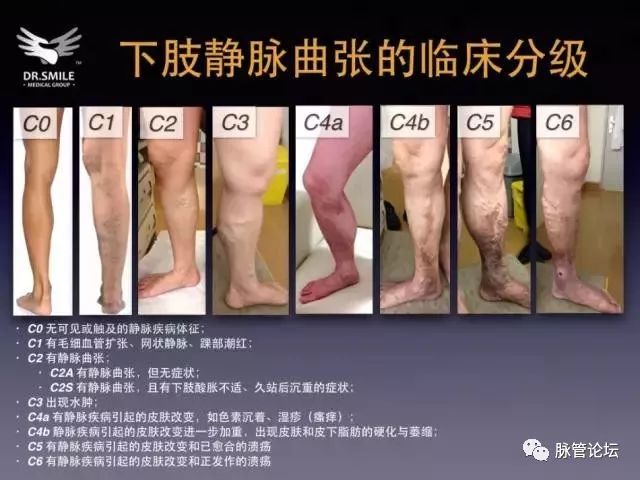 医生彻底根治静脉曲张的特效方法,广州中医治疗静脉曲张的10大忌