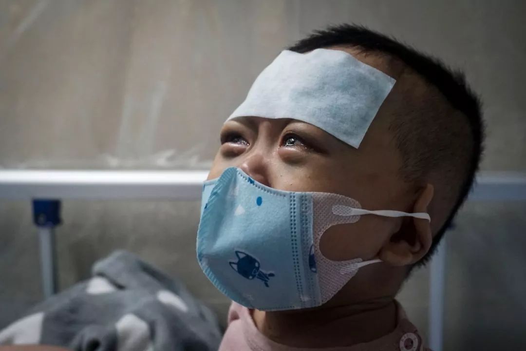 小男孩双眼淤青肿胀，酷似熊猫眼，父母曾被人怀疑虐待孩子