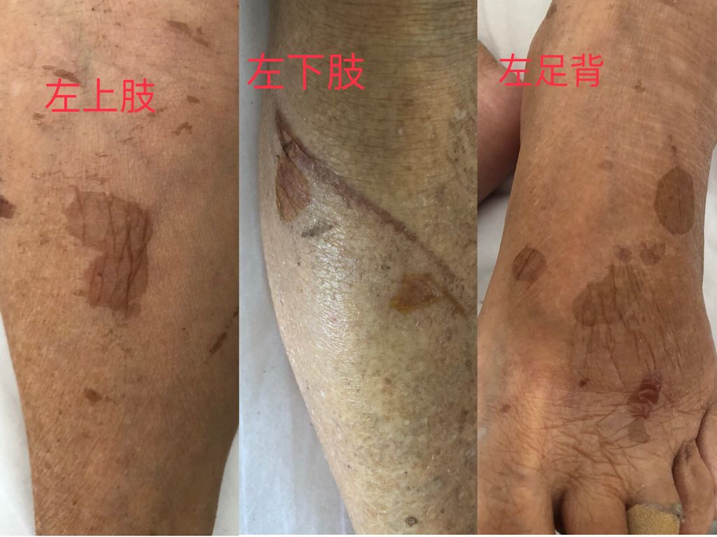 长水泡是什么前兆,一般长水泡的原因是什么