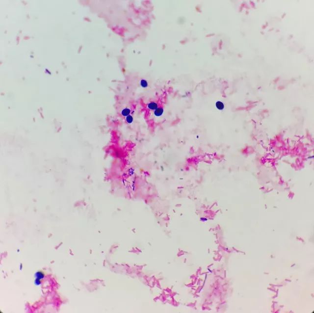 儿童大便里有霉菌的治疗,小孩粪便检查出霉菌