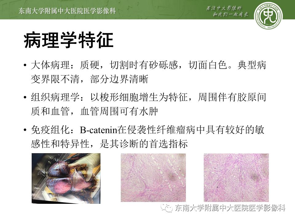 侵袭性纤维瘤影像学表现,侵袭性纤维瘤病影像上易诊断吗