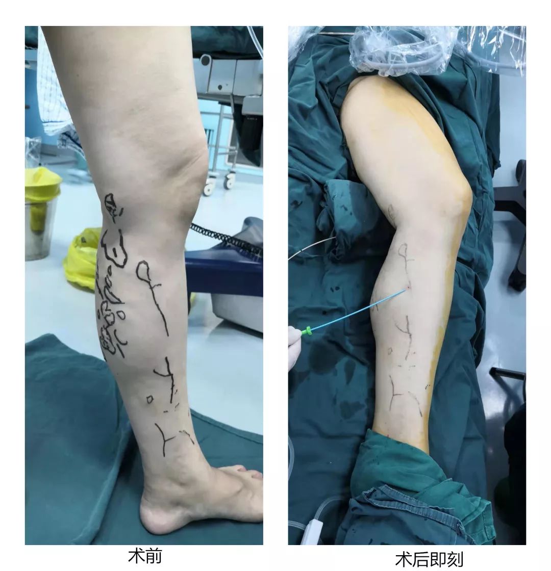 静脉曲张怎么保护好腿,夏季静脉曲张护腿