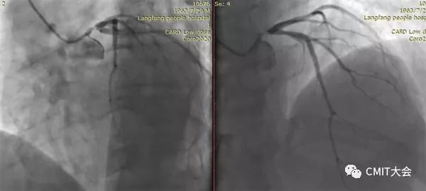 冠脉造影技术成熟不,跟我学技术分析从入门到精通