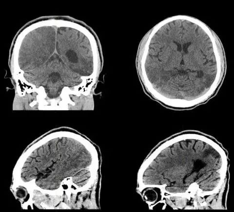 平山病、MELAS、MVNT、ODS丨3分钟读片·第15期