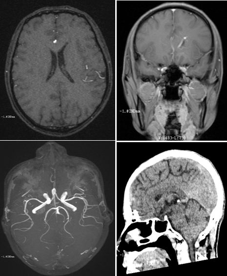 平山病、MELAS、MVNT、ODS丨3分钟读片·第15期