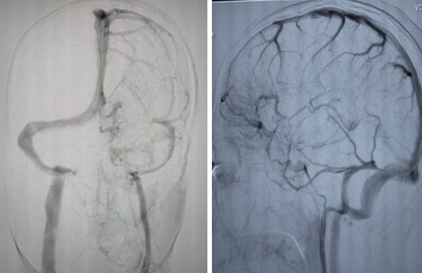 平山病、MELAS、MVNT、ODS丨3分钟读片·第15期