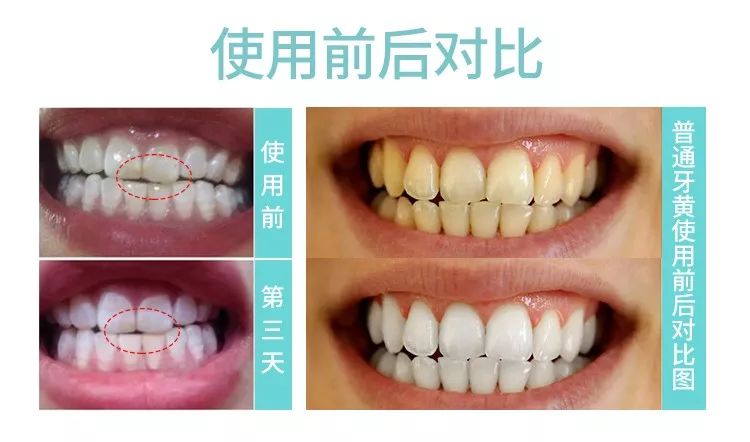 俄罗斯牙膏去黄牙怎么样,祛牙垢黄牙的牙膏国货之光