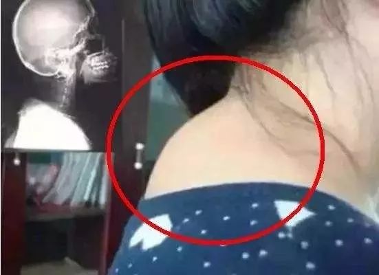 富贵包导致脖子筋痛用什么治疗,富贵包消除的最佳神器