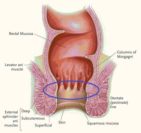 大便就像拉水一样啥病,排便感强烈但排不出还很疼痔疮