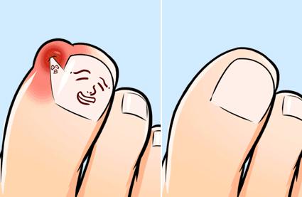 烦人的甲沟炎到底该咋办,特别严重的甲沟炎