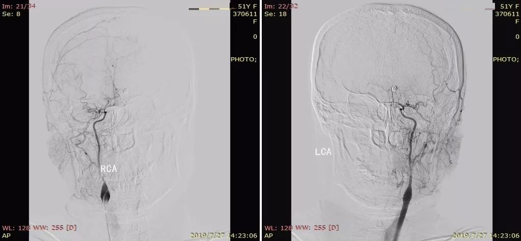 物华天宝·第12期｜复发多发动脉瘤合并烟雾病的支架辅助弹簧圈栓塞治疗