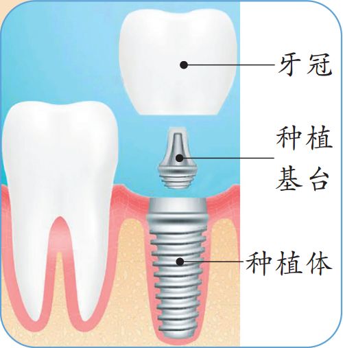 一颗牙齿1000多,种牙三甲医院贵还是口腔医院贵