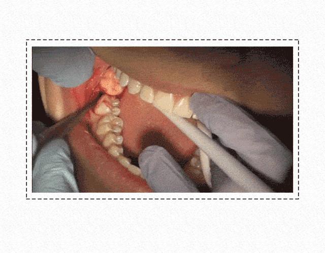 拔智齿的全过程漫画,智齿漫画版