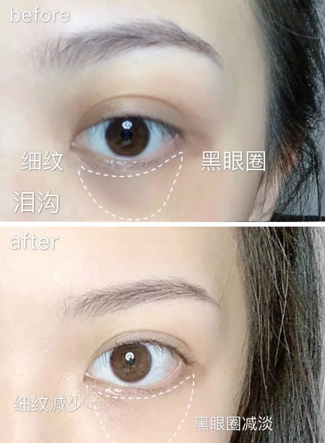 法令纹和眼纹怎么才能有效改善,法令纹贴眼贴有用吗