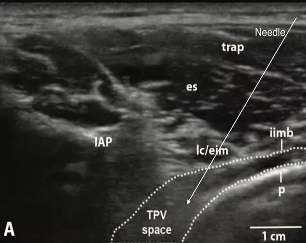 胸椎旁神经阻滞时需要穿过的韧带,胸椎旁神经阻滞超声探头位置