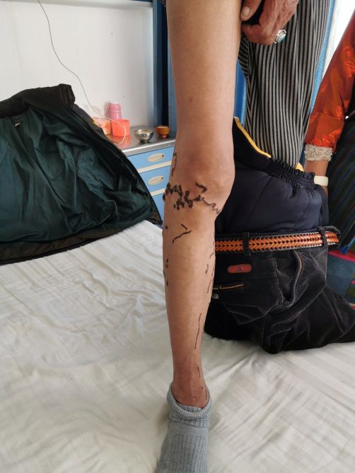 下肢静脉曲张外科手术,日喀则首例静脉曲张微创手术