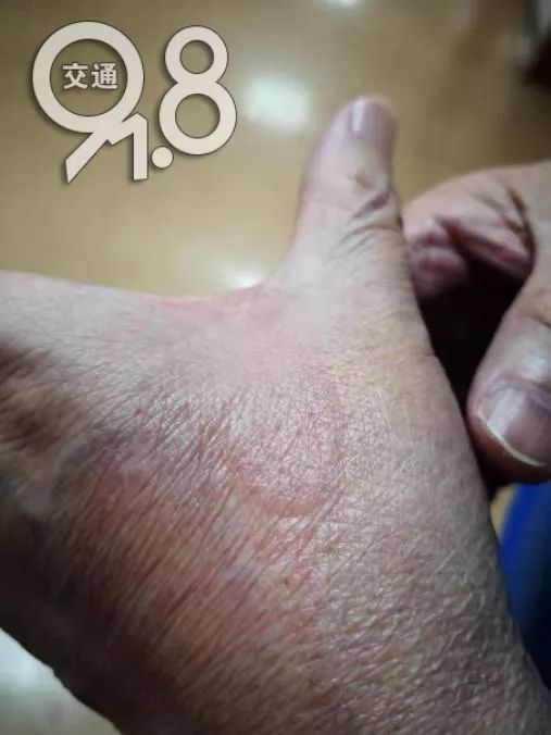 4岁小孩眼睛被腐蚀,强酸液体滴进孩子眼睛