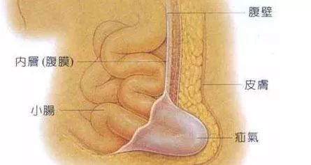 勿以“疝”小而不为，也有可能随时会要命