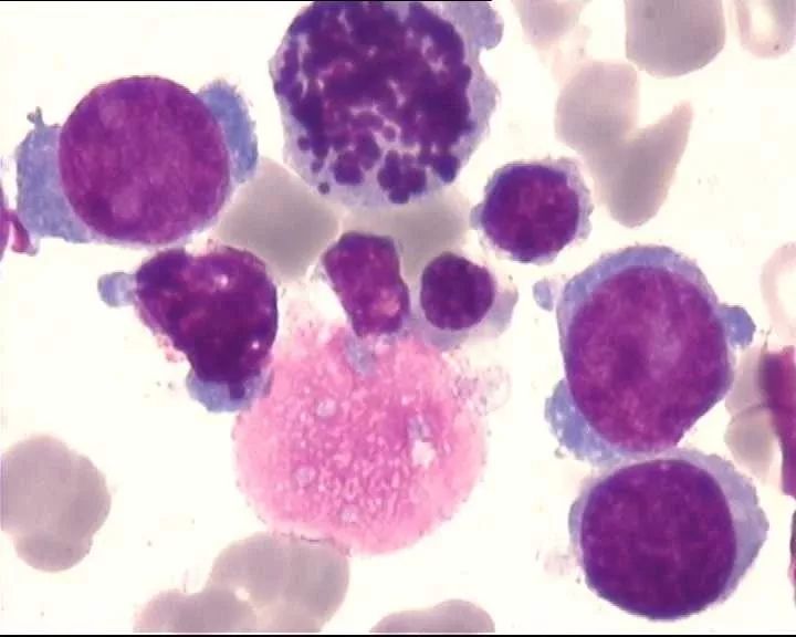 全血细胞减少疾病，你还傻傻分不清？